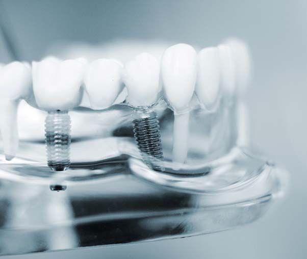 Traditional dental implants in clear model of jawbone