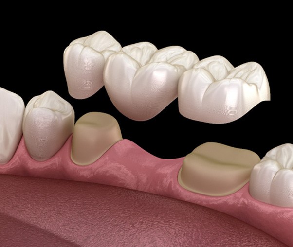 Digital illustration of a dental bridge