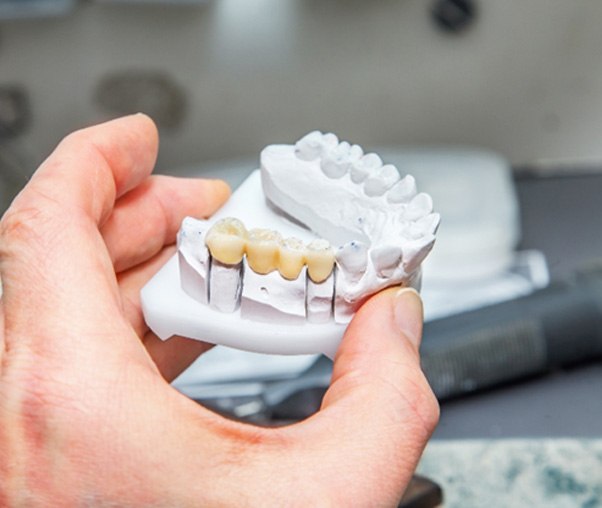 Dental bridge on a clay model