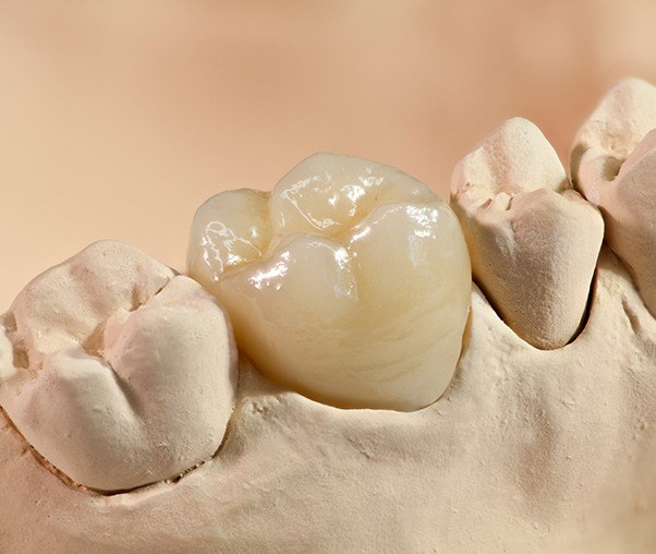 Model smile with dental crowns restoration