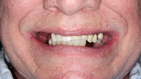 Yellowed and unhealthy smile before cosmetic dentistry