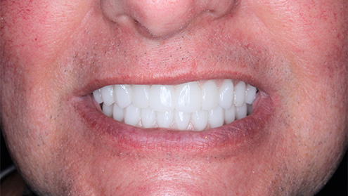 Healthy white smile after cosmetic dentistry