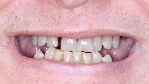 Yellowed and unhealthy smile before cosmetic dentistry