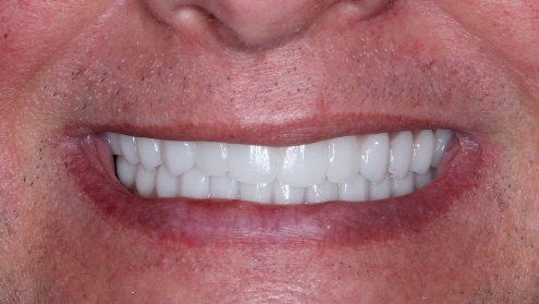 Healthy white smile after cosmetic dentistry