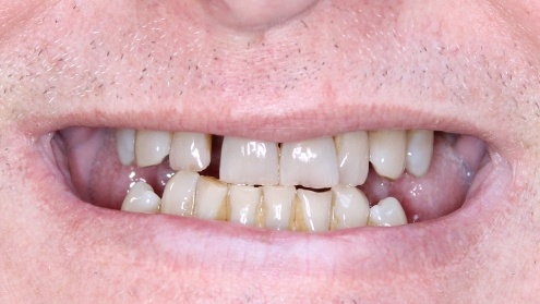 Yellowed and unhealthy smile before cosmetic dentistry