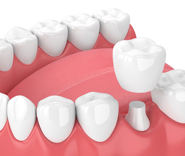 3D illustration of a same-day crown capping a prepared tooth