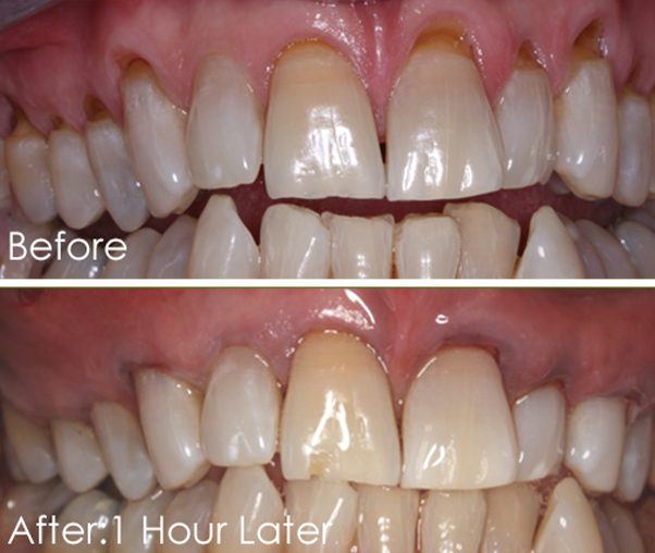 Smile before and after Chao pinhole surgical technique treatment