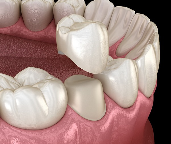 3D illustration of a dental crown capping a prepared tooth