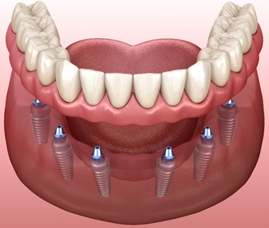 Digital illustration of implant denture