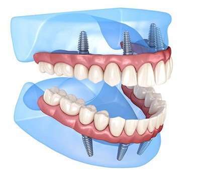 Illustration of All-on-4 dentures for upper and lower dental arches
