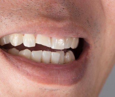 Smile with chipped front tooth