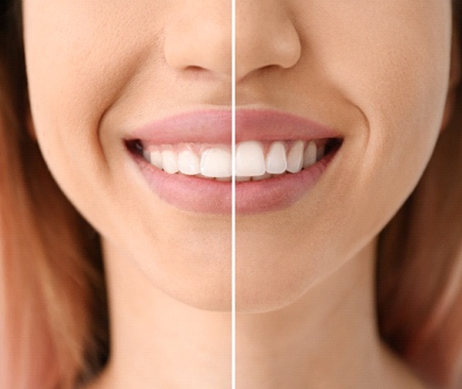 A side-by-side view of a young woman who underwent gum recontouring to expose more natural tooth structure