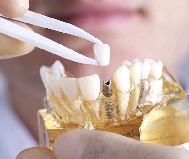 Understanding cost of dental implants in Carrollton