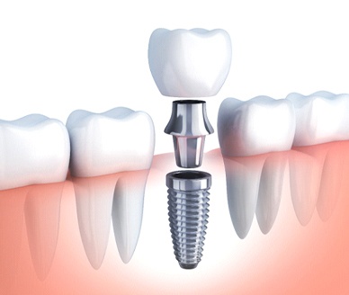 Dental implant in Carrollton