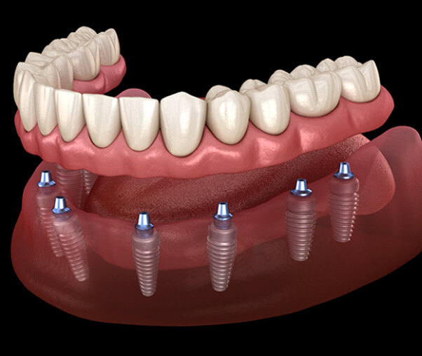 Implant dentures in Carrollton