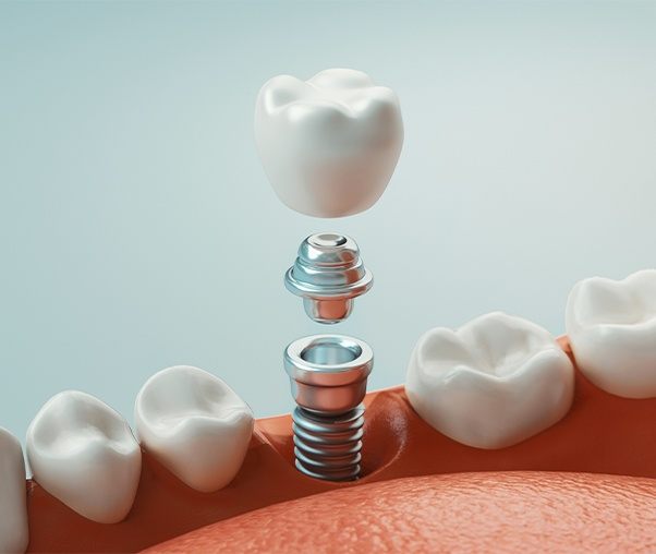 Animated parts of a dental supported implant replacement tooth