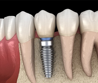 Animated dental implant supported dental crown