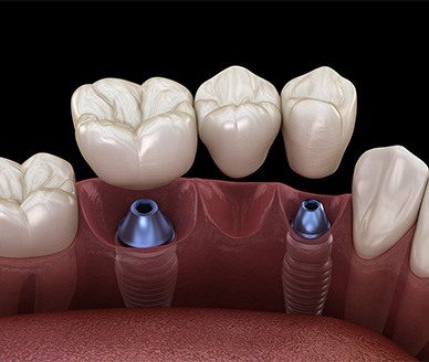 Animated dental implant supported fixed bridge