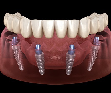 Animated dnetal implant supported denture