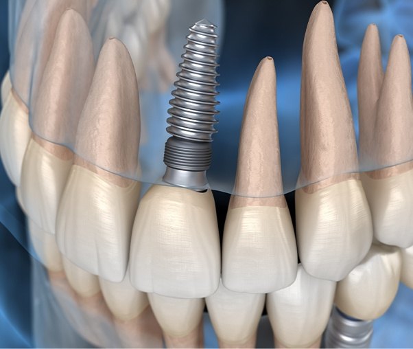 Animated dental implant supported replacement tooth within smile line