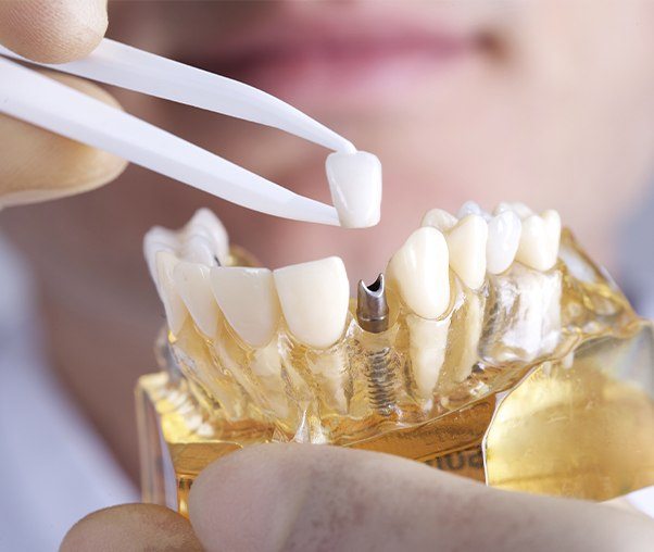 Model smile with dental implant supported dental crown