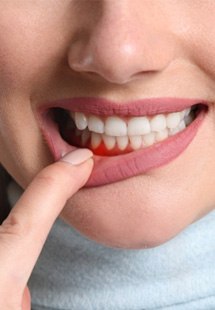 woman pointing to inflamed gums 