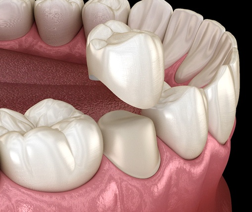 A digital image of a ceramic dental crown being placed over a weakened tooth on the lower arch