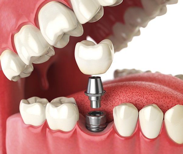 Animated dental implant supported dental crown placement