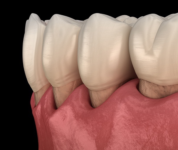 Animated smile with receding gums due to untreated gum disease