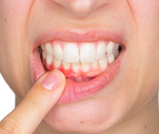 Patient pointing to red gum tissue