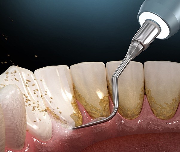 Animated deep teeth and gum cleaning periodontal therapy