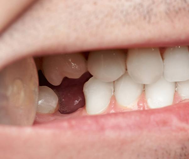 Periodontal Therapy Carrollton, TX | Gum Disease | Oral Health