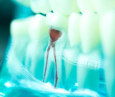 a tooth representing the cost of root canal in Carrollton