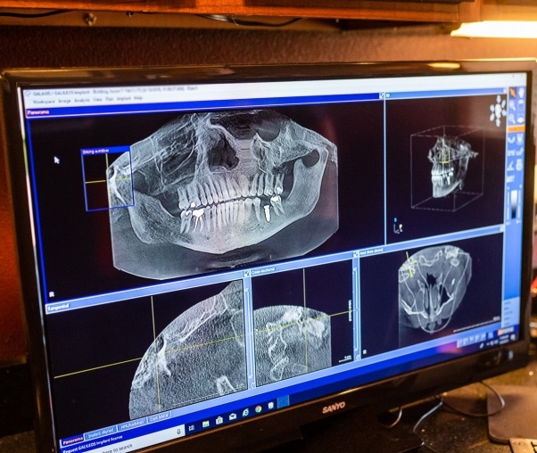 Digital x rays of teeth on computer screen