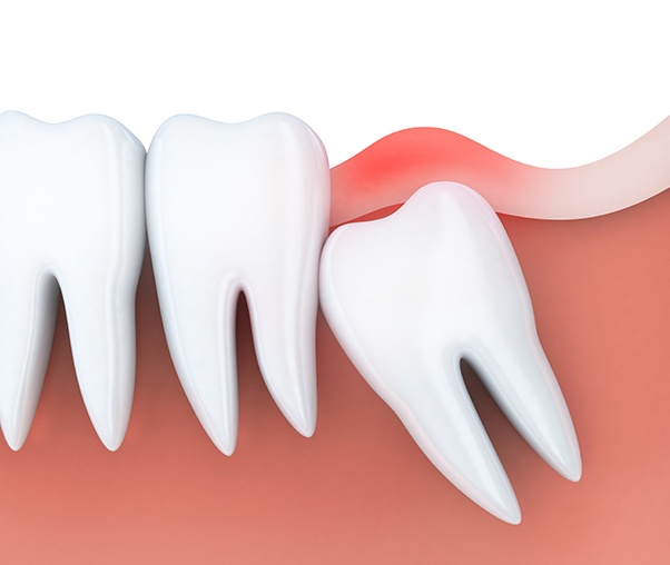 Animated smile with impacted wisdom tooth