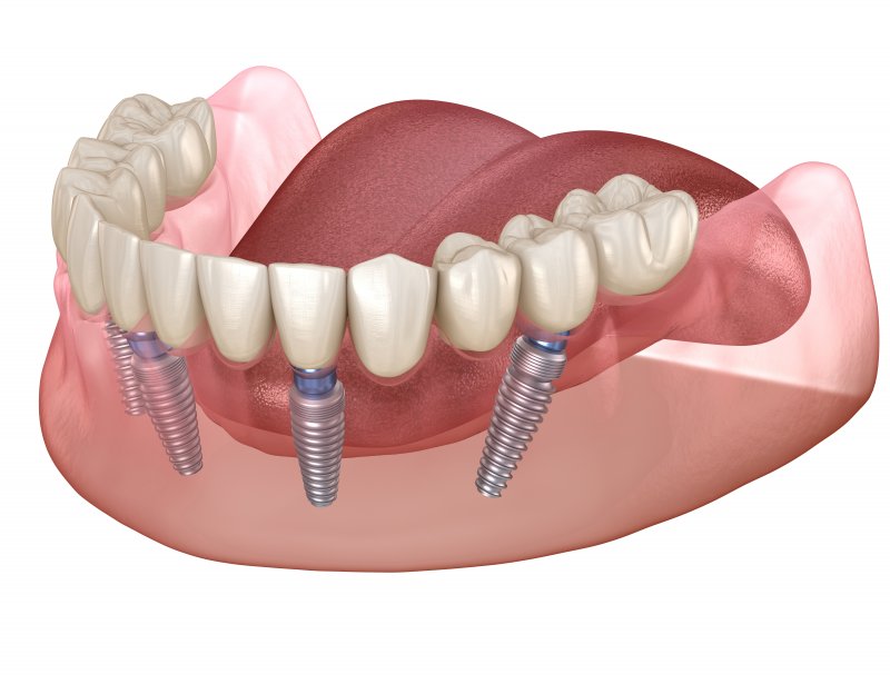 implant dentures in Carrollton 