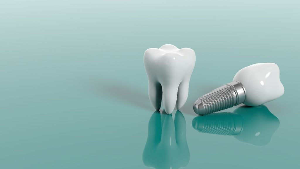 When is Removing a Failed Dental Implant Necessary?