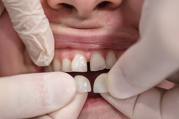dentist holding different types of veneers up to patients’ teeth