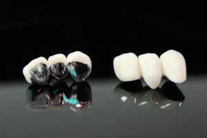 Sample porcelain-fused-to-metal restorations on a black background