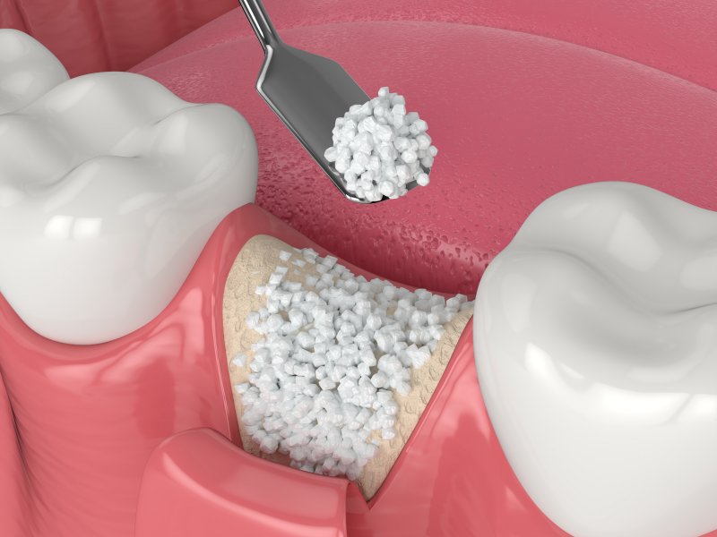 A 3D illustration of a dental bone graft