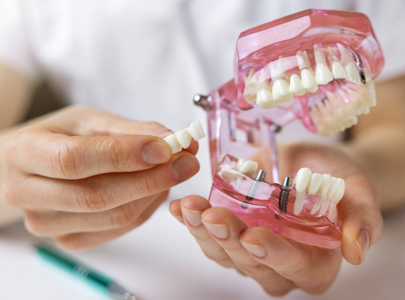 Dental implant model