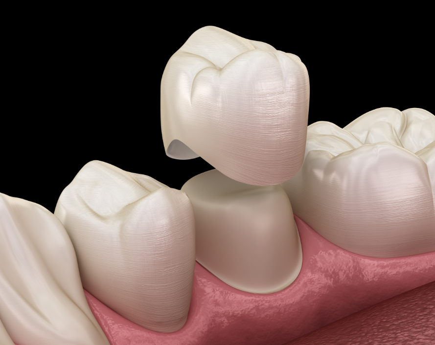 3D image of a dental crown